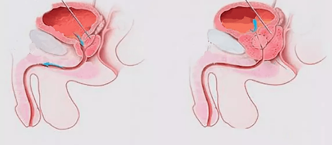 Signs of prostate to men