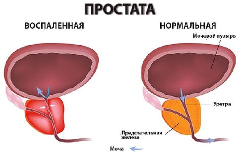 prostate