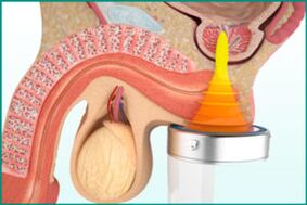 Treatment of prostatitis