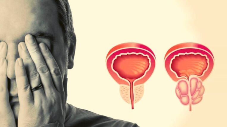 A man has prostate