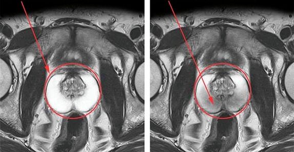 Normal prostate (left) and inflammation of the prostate with prostatitis (right)